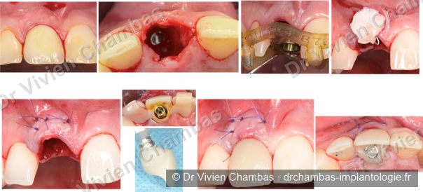 Avulsion d'une dent antérieure, pose d'implant guidée, dent provisoire immédiate et greffe gingivale en un temps, Lyon