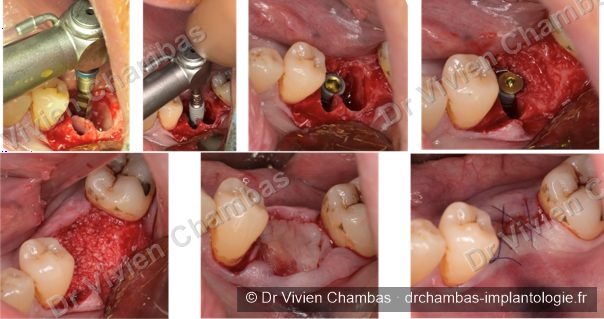 Avulsion de dents postérieures et pose d'un implant immédiat par le Dr Vivien Chambas à Lyon