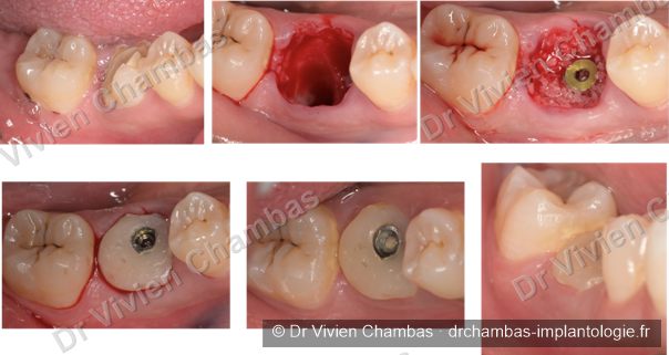 Pose d'implant immédiat et conformation gingivale à l'aide d'un pilier personnalisé, Lyon