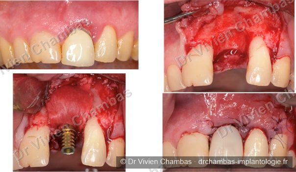 Avulsion dentaire, pose d'implant immédiat, reconstruction osseuse et couronne provisoire en résine à Lyon