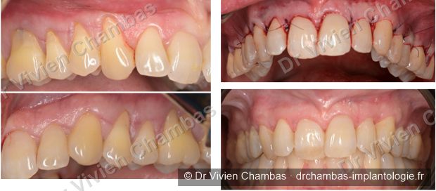 Chirurgie gingivale d'une arcade complète présentant des récessions sur toutes les dents, Lyon