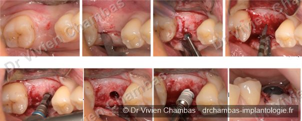 Étapes chirurgicales de la pose d'un implant dentaire simple par le Dr Vivien Chambas à Lyon