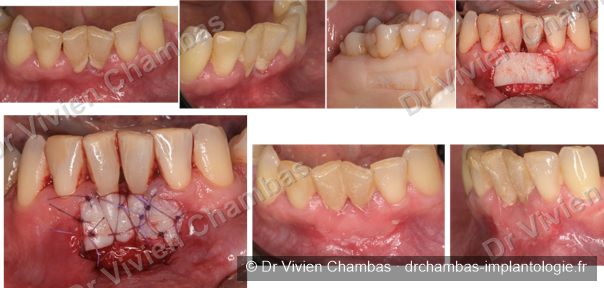 Greffe gingivale de renfort des dents mandibulaires antérieures réalisée à Lyon