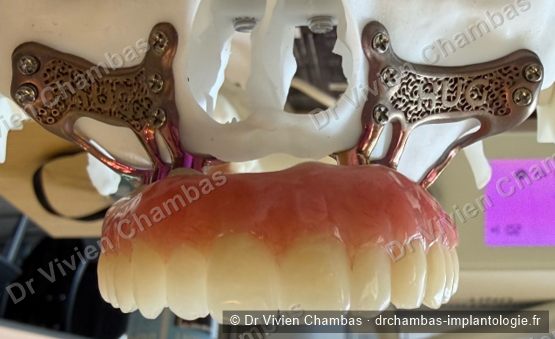 Implant sur mesure sous-périosté conçu pour les cas d'atrophie osseuse sévère, Lyon