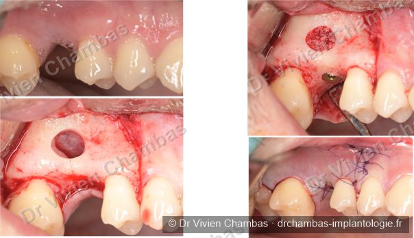 Sinus lift (augmentation osseuse sinusienne) avec pose d'implant simultanée à Lyon